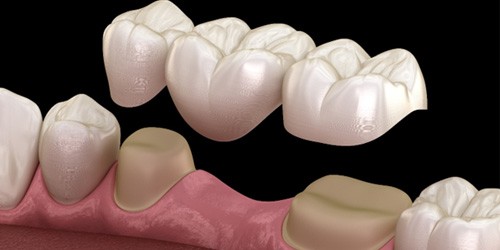 a digital design showing how a dental bridge fits over teeth 