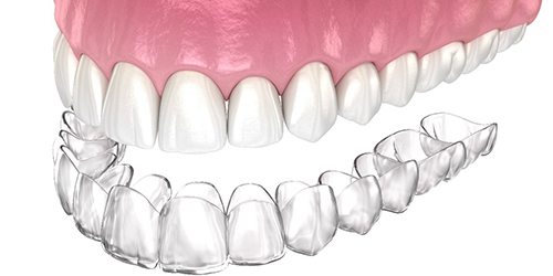 Digital image of a top row of teeth and a clear aligner sitting directly underneath the teeth to show the type of fit and customization they offer
