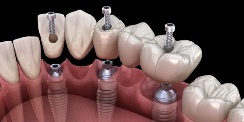 a digital illustration depicting how an implant bridge works 
