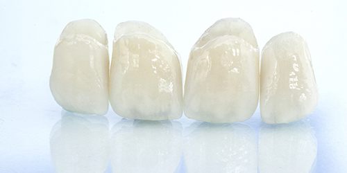 All-ceramic restorations at dentist.