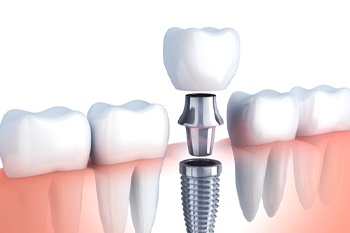 dental implant with abutment and crown in the lower jaw
