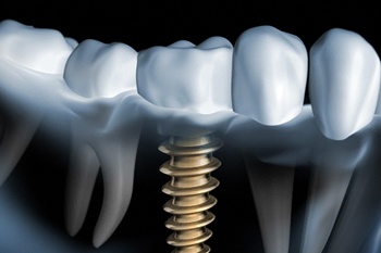 X-ray of a patient with one dental implant