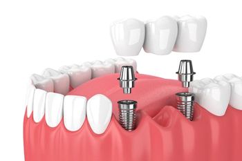 dental bridge being placed on two dental implants
