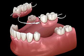 illustration for partial dentures in Plano 