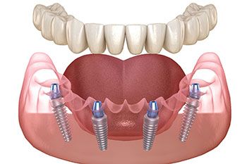 illustration for implant dentures in Plano 