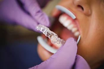 Plano dentist placing Invisalign on patient's teeth
