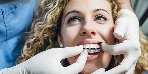 Dentist placing Invisalign in Plano on patient's teeth