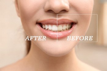 Closeup of patient's teeth before and after professional teeth whitening