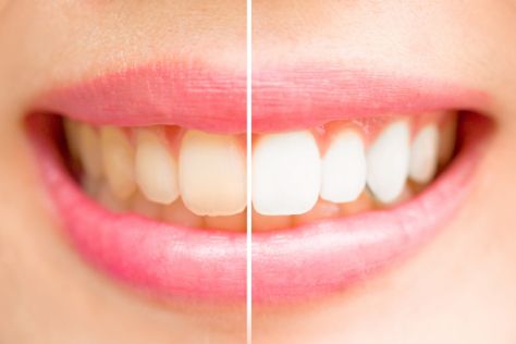 A smile before and after teeth whitening