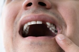 closeup of missing front teeth needing dental implants in Plano