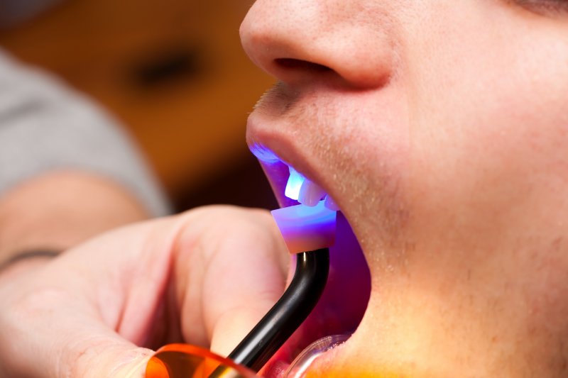 A dentist performing dental bonding